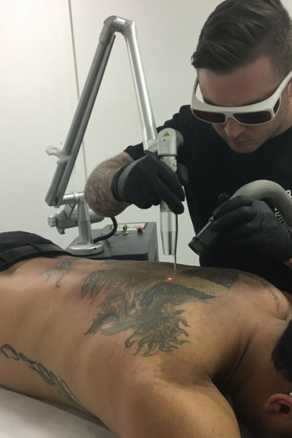 Tattoo Removal in Brussels - Treatwell