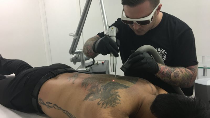 Book Your Laser Tattoo Removal Sessions — Nude Skin Tattoo Removal